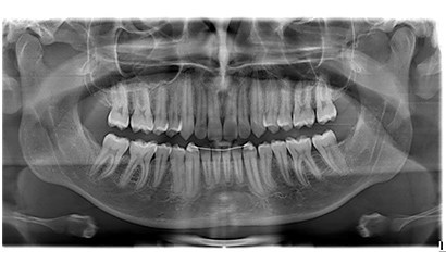 Radiografia de maxilar y mandibula